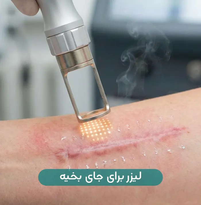 لیزر co2 جای بخیه