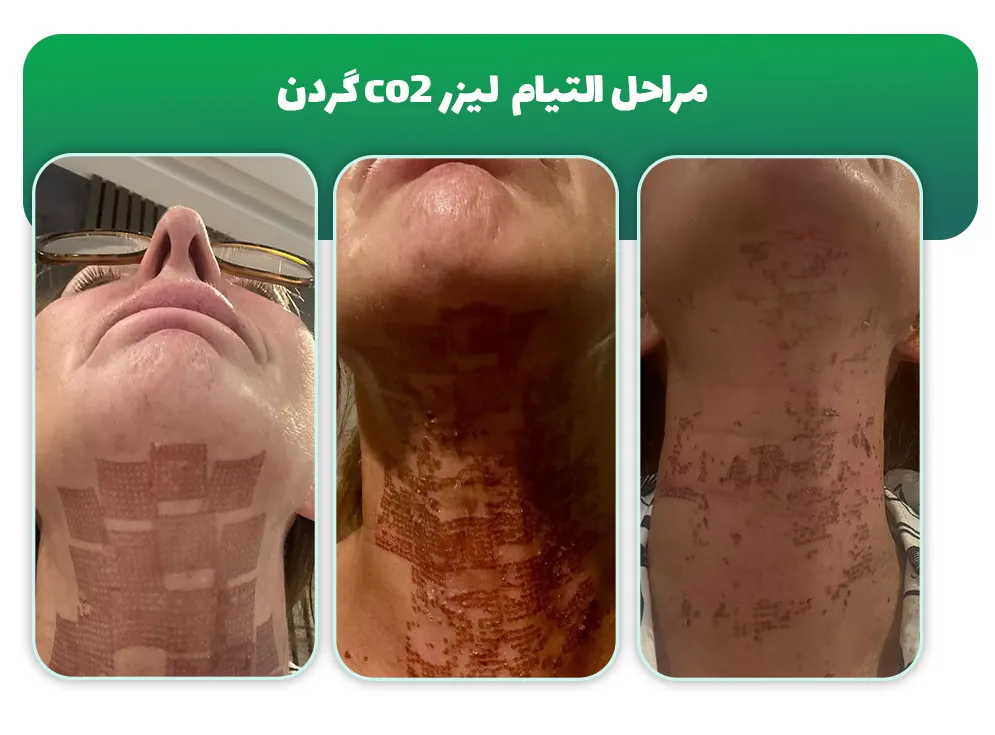 مرحل درمان بعد لیزر co2