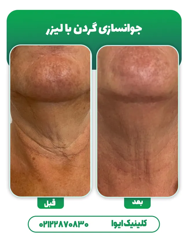 جوانسازی گردن با لیزر
