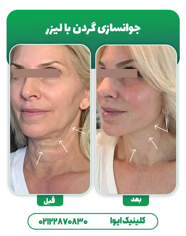 جوانسازی گردن با لیزر