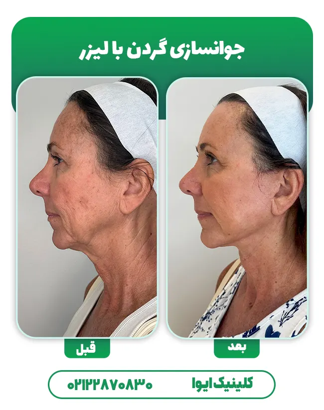 جوانسازی گردن با لیزر