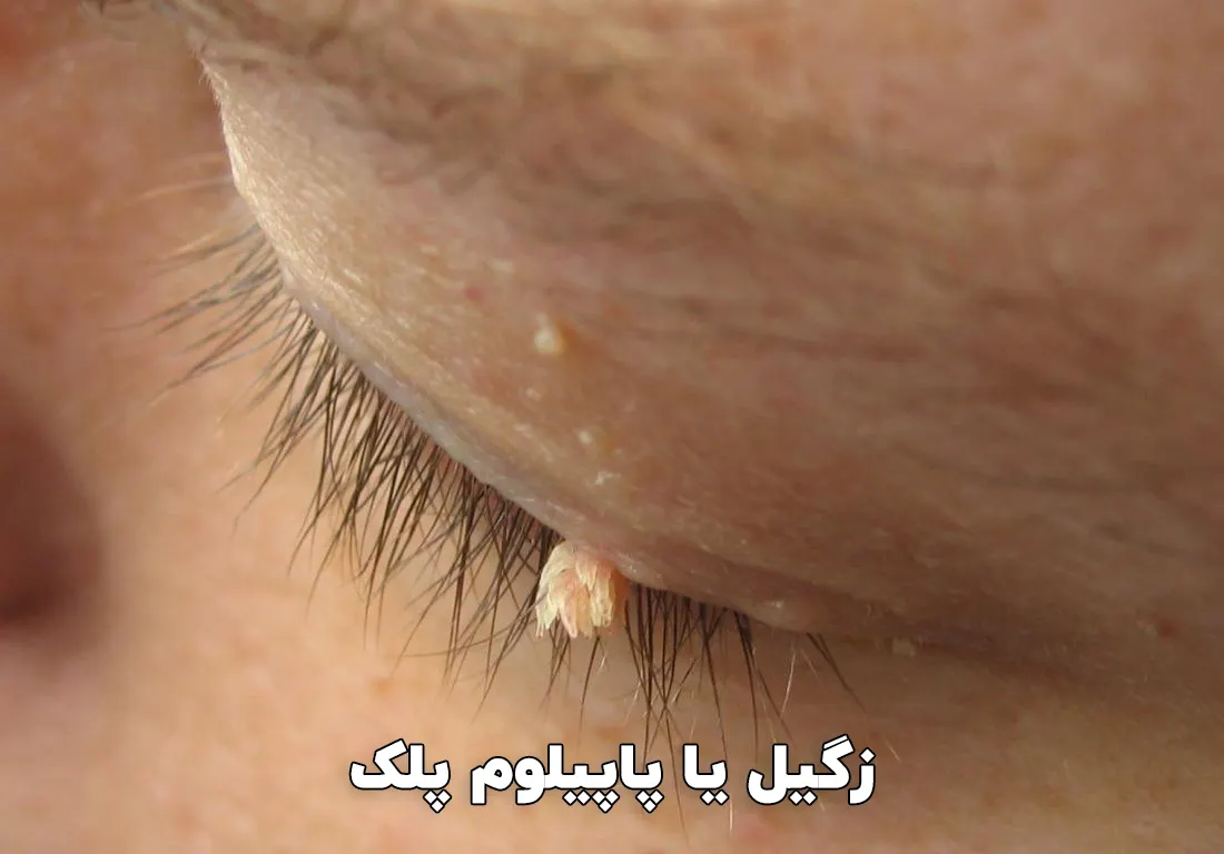 زگیل پلک