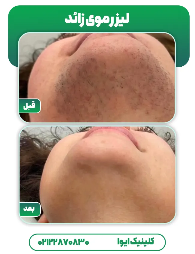 لیزر موی زائد