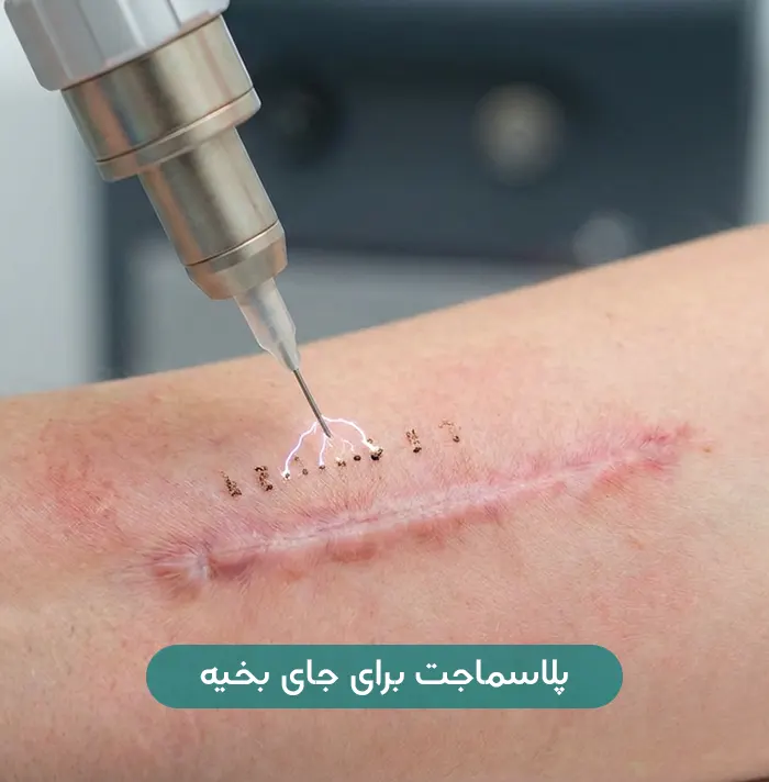 پلاسماجت جای بخیه