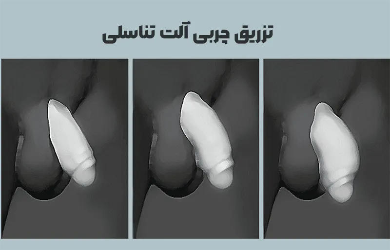 تزریق چربی آلت تناسلی