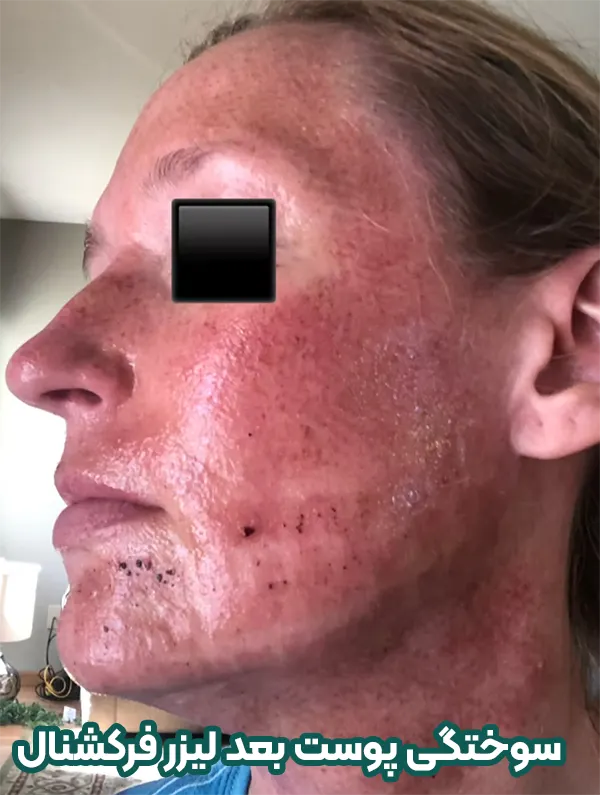 سوختگی بعد از لیزر CO2