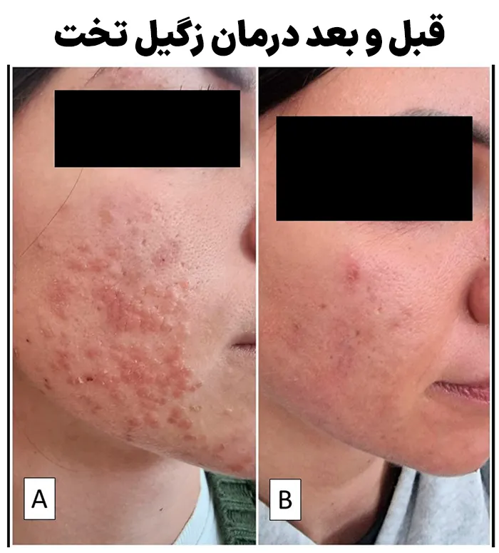 قبل و بعد درمان زگیل تخت