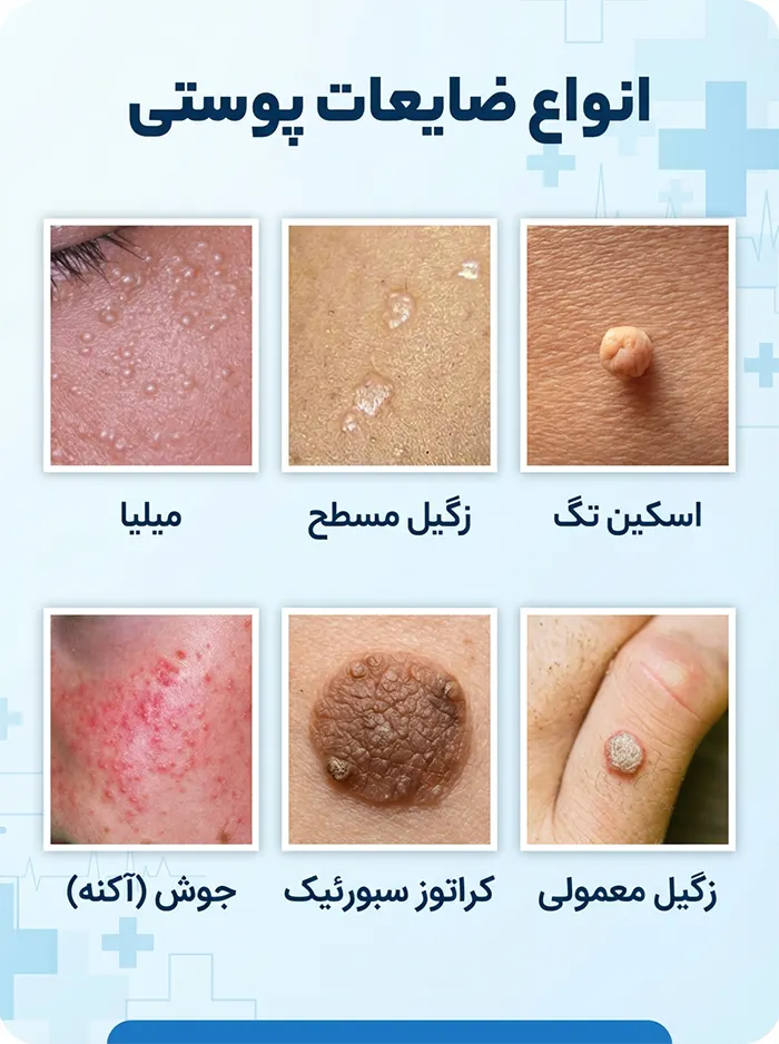 تفاوت زگیل تخت با سایر ضایعات پوستی