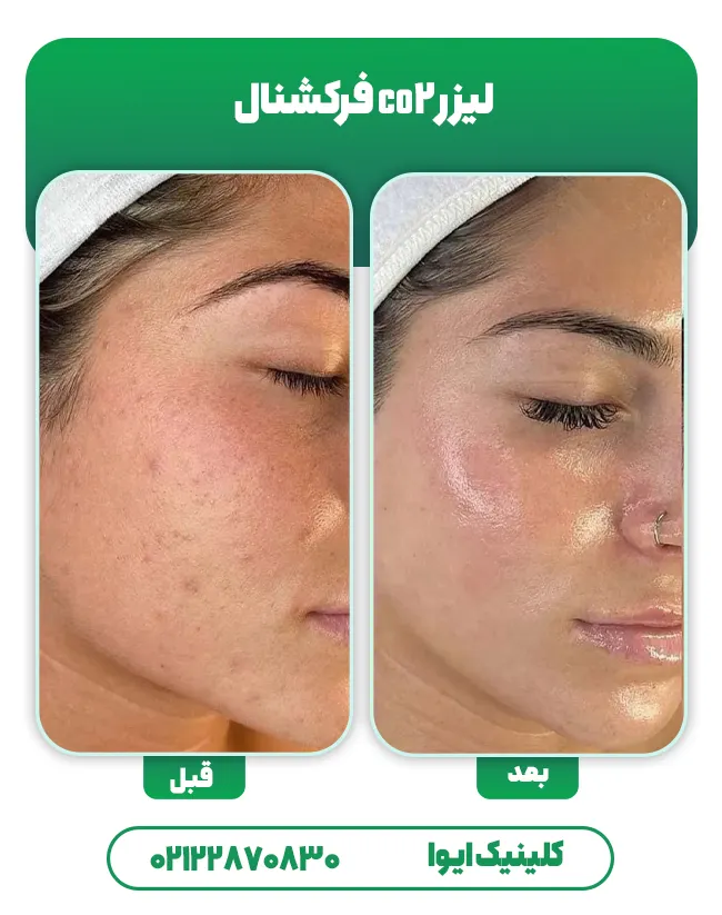 قبل بعد لیزر co2 فرکشنال