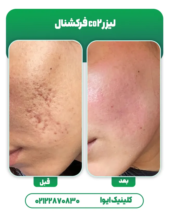 قبل بعد لیزر co2 فرکشنال