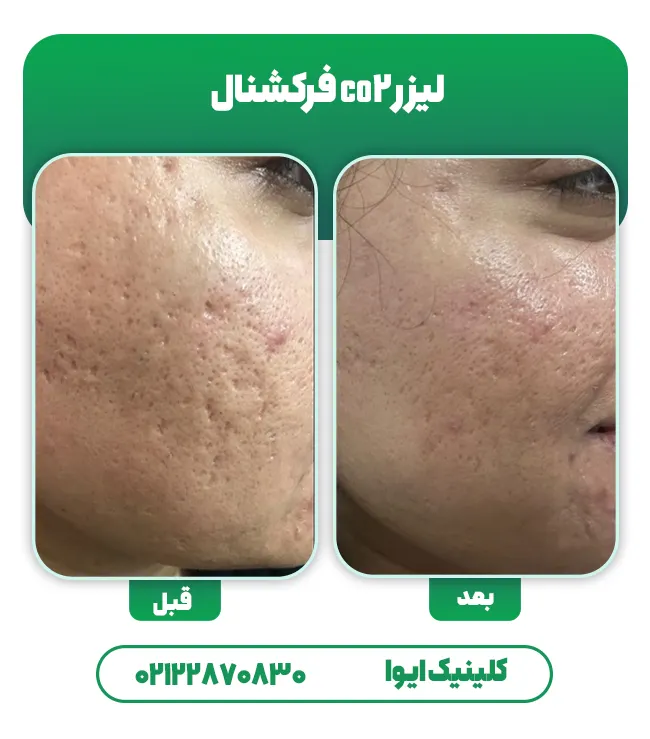 قبل بعد لیزر co2 فرکشنال