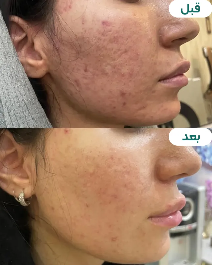 قبل بعد لیزر co2 فرکشنال