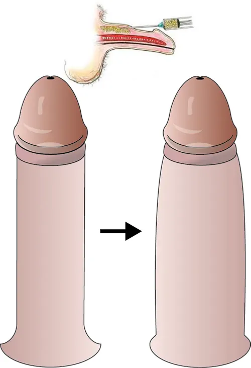 تزریق فیلر آلت تناسلی