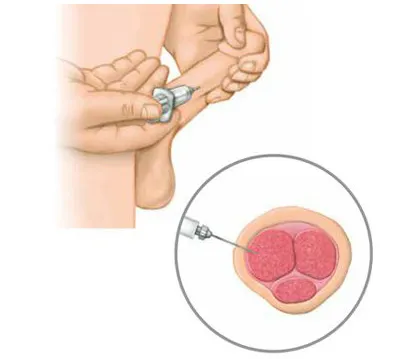 فیلر آلت تناسلی