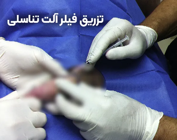 تزریق ژل آلت تناسلی