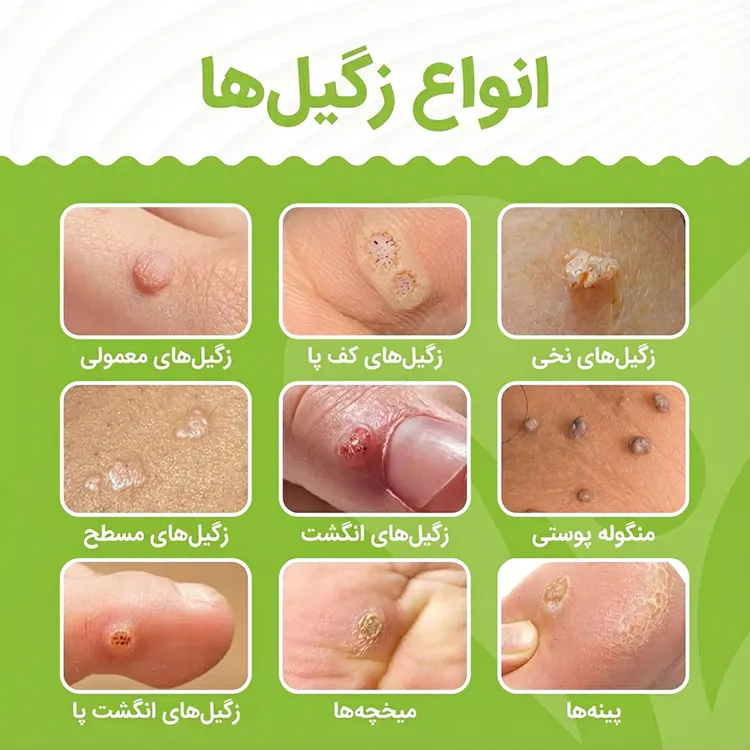 انواع زگیل پوستی