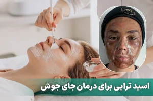 اسید تراپی برای درمان جای جوش