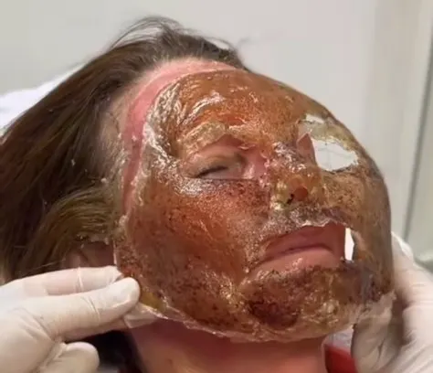 اسید تراپی برای درمان جای جوش