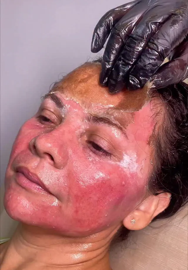 عوارض احتمالی پیلینگ جای جوش