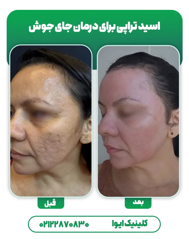 درمان جای جوش با اسید تراپی