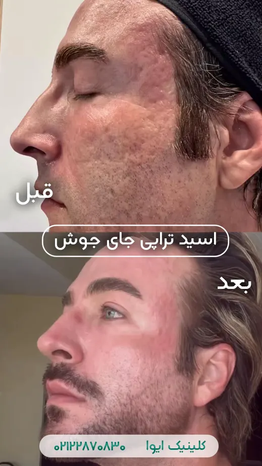 اسید تراپی برای درمان جای جوش