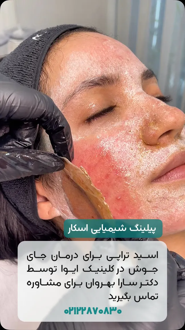 درمان جای جوش با پیلینگ شیمیایی