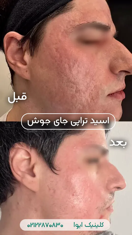 درمان جای جوش با اسید تراپی