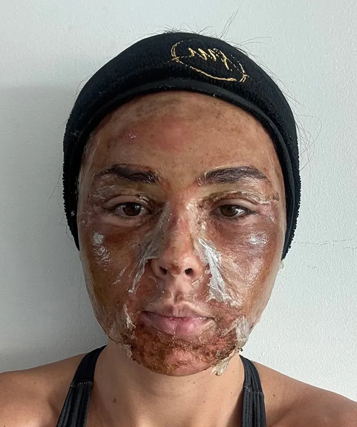 درمان جای جوش با اسید تراپی