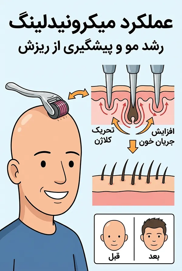 مکانیسم میکرونیدلینگ مو
