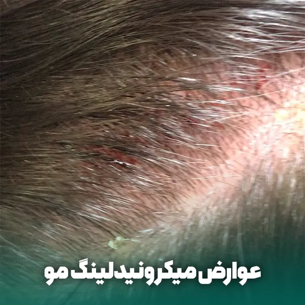 عوارض جانبی میکرونیدلینگ مو