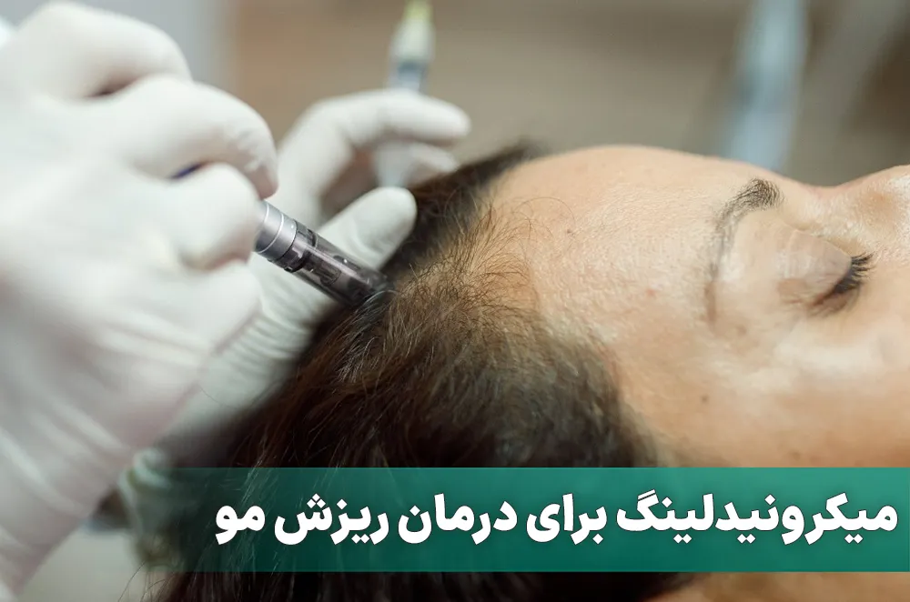 میکرونیدلینگ برای درمان ریزش مو