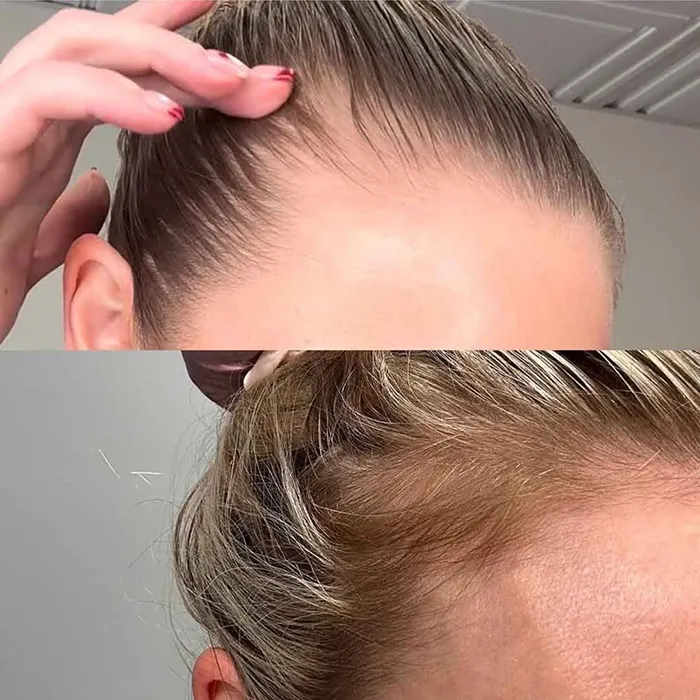 میکرونیدلینگ مو