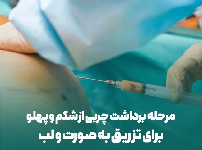 برداشت چربی برای تزریق به لب