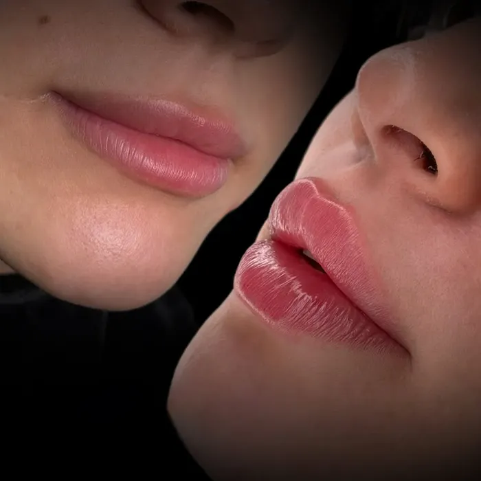 تزریق چربی لب