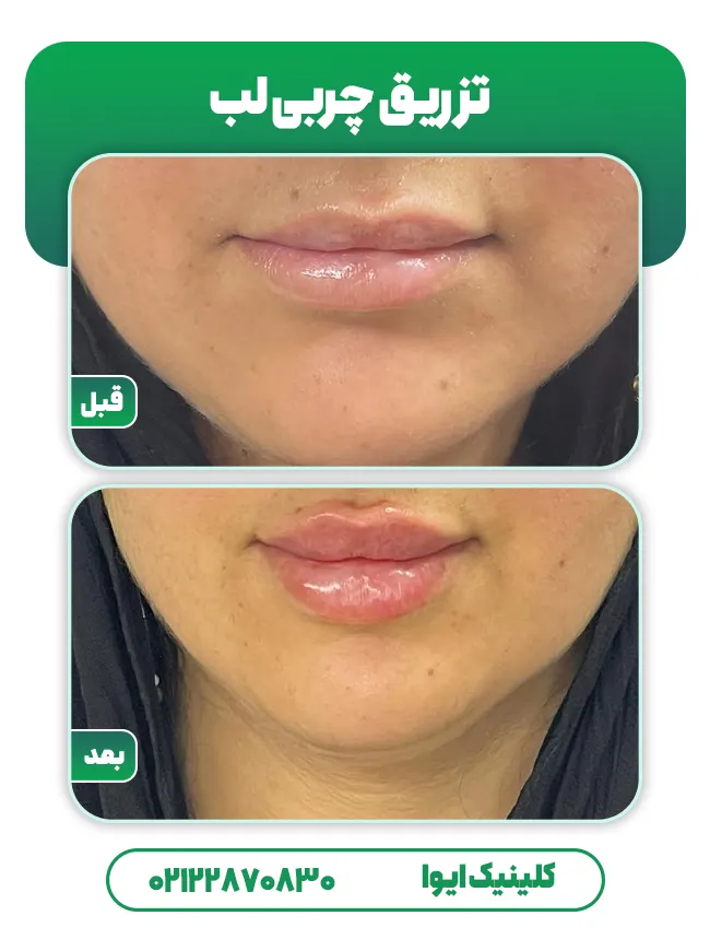 تزریق چربی لب