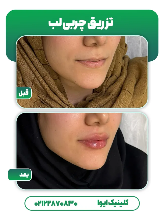 تزریق چربی لب