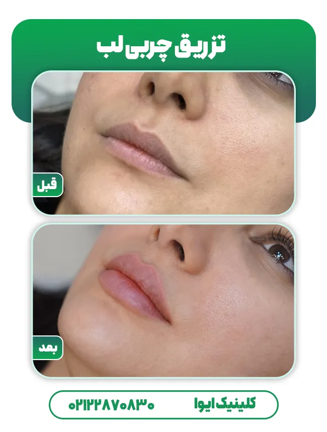 تزریق چربی لب