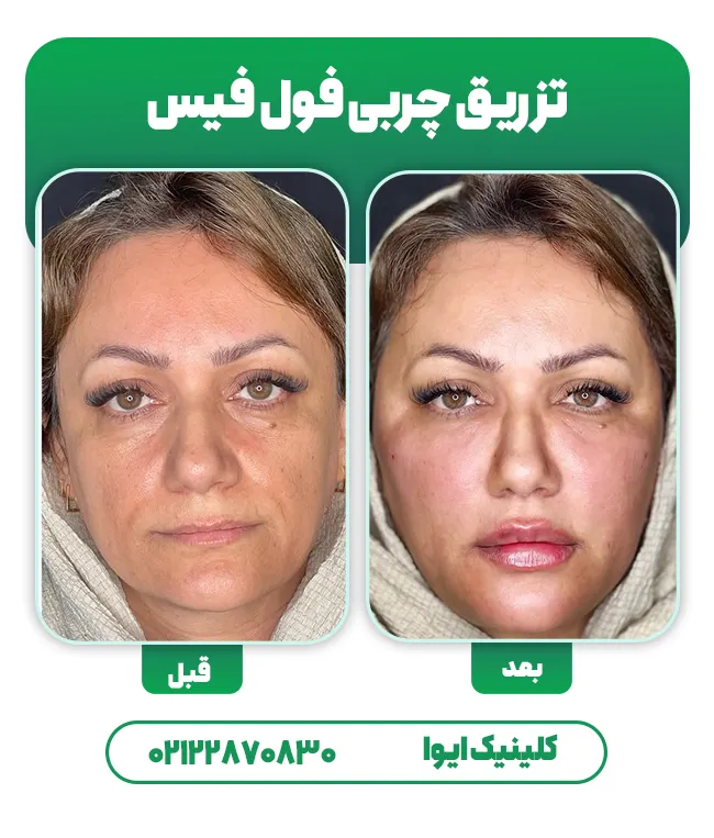 تزریق چربی صورت فول فیس