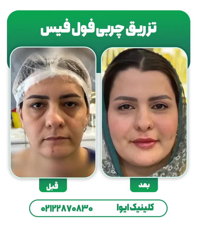 تزریق چربی صورت و لب