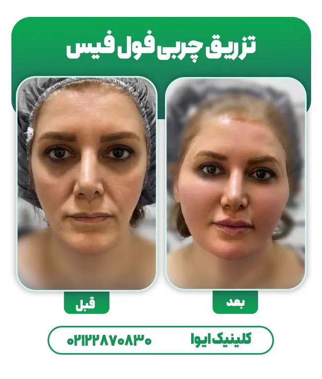 تزریق چربی صورت