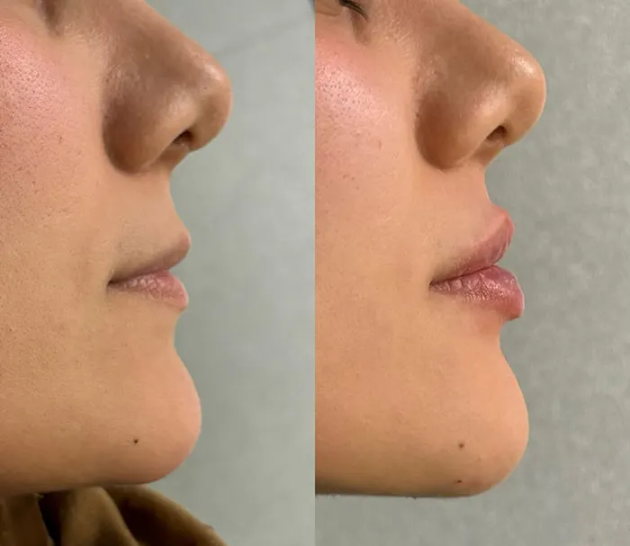 تزریق چربی لب