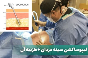 لیپوساکشن سینه مردان