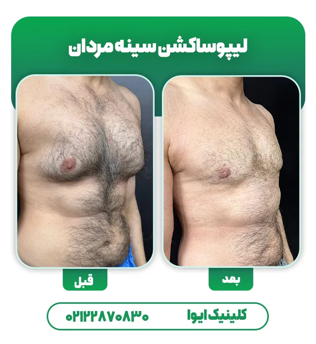 لیپوساکشن سینه مردان