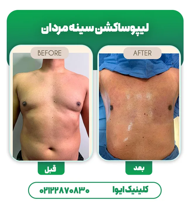 لیپوساکشن سینه مردان