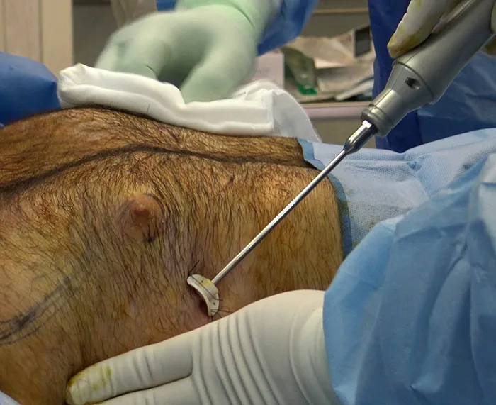 لیپوساکشن سینه مردان