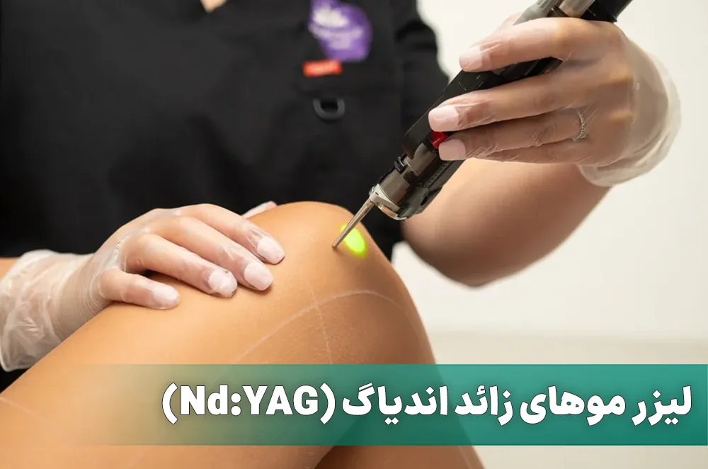 لیزر موهای زائد اندیاگ