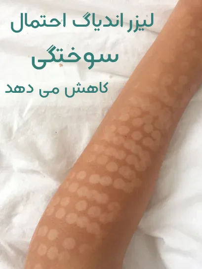 سوختگی بعد لیزر مو