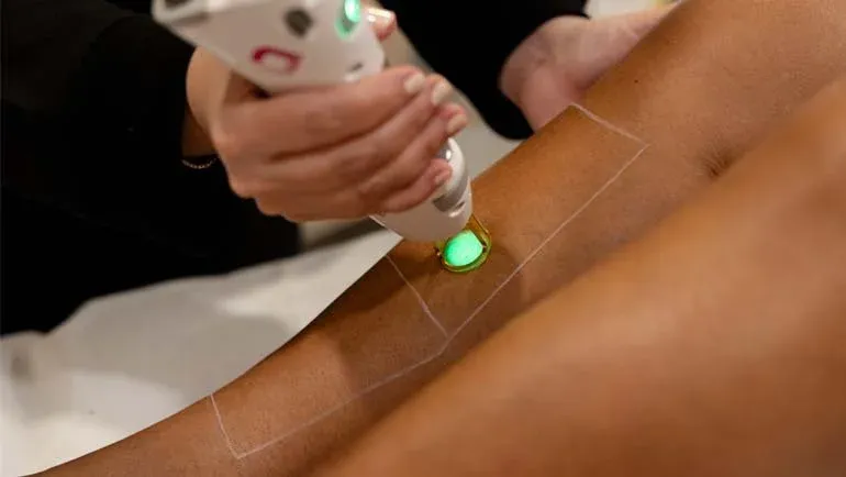 لیزر موهای زائد اندیاگ