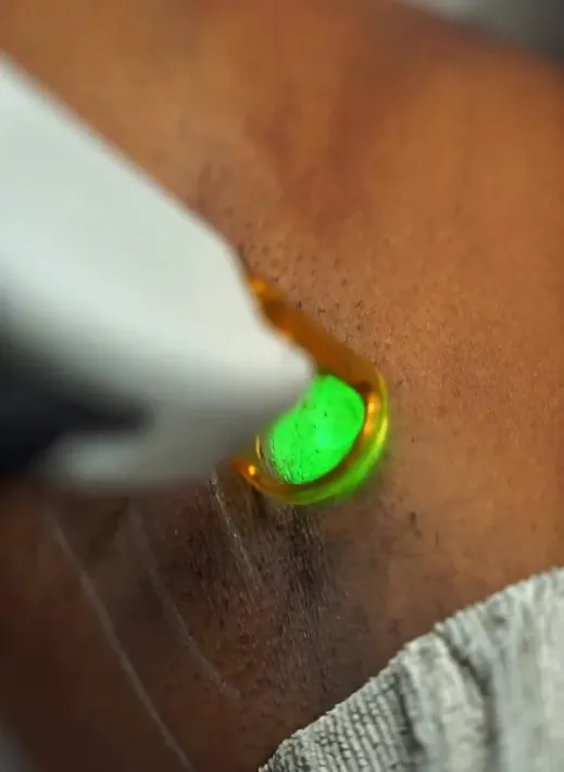 لیزر موهای زائد اندیاگ