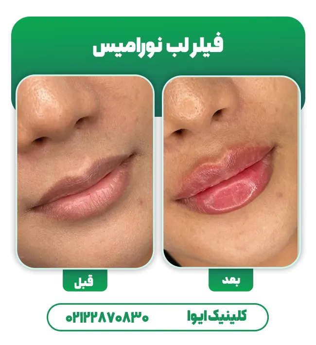 ژل لب نورامیس